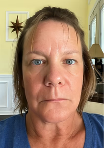 Before - “Took 10 years off my face.”