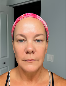 After - “Took 10 years off my face.”