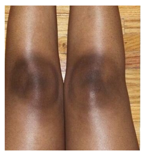 Before - Didn’t think my knees could ever look like this