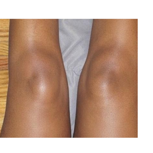 After - Didn’t think my knees could ever look like this