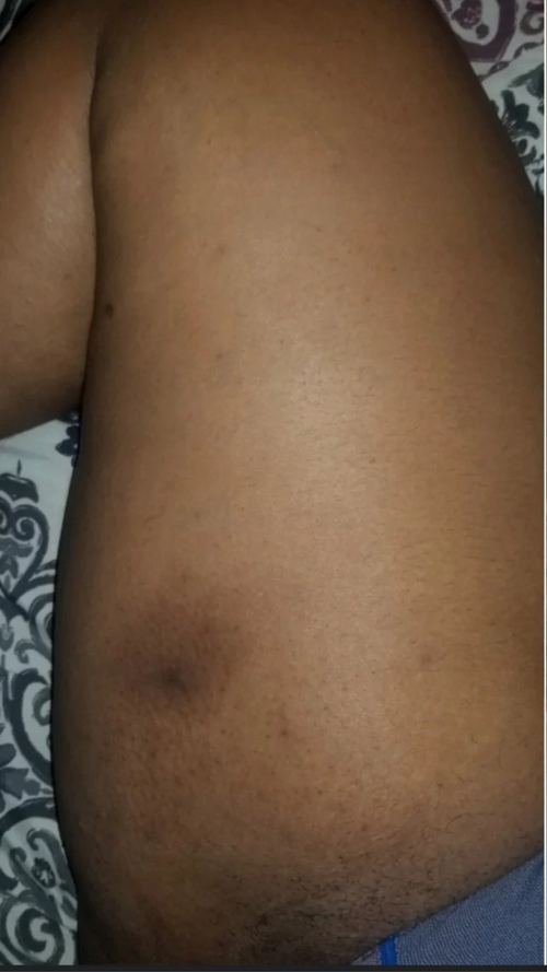 Before - Visible results in just 2 weeks