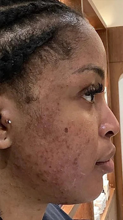 Before - This cleared up what makeup couldn’t