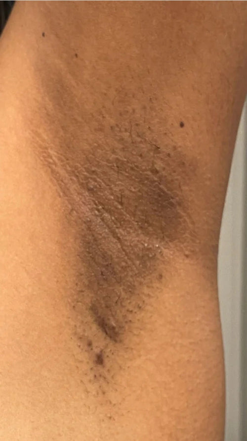 Before - I stopped hiding my underarms!