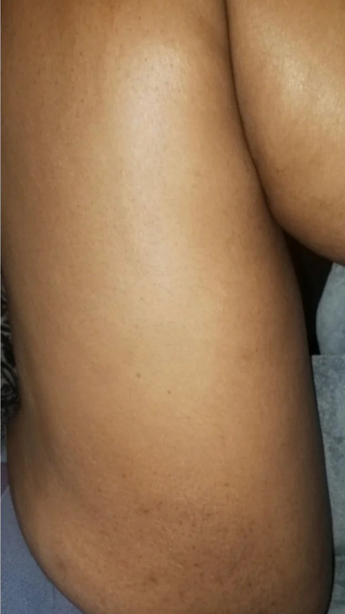 After - Visible results in just 2 weeks