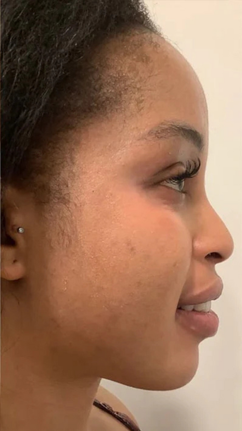 After - This cleared up what makeup couldn’t